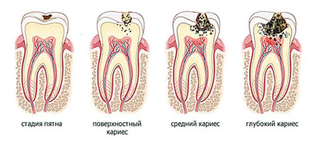 Лечение кариеса в стоматологии